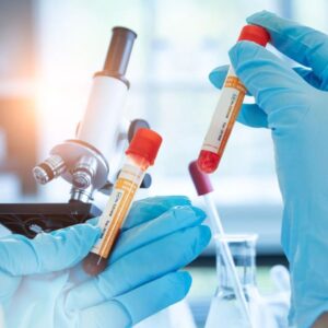 Adenosine Deaminase, Serum